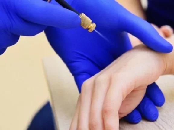 Nitrogênio Líquido: a solução de Air Liquide para os profissionais de Dermatologia