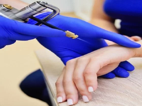 Criocirurgia: Método eficaz no tratamento de lesões da pele