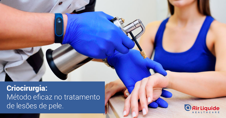 Criocirurgia: Método eficaz no tratamento de lesões da pele (2)